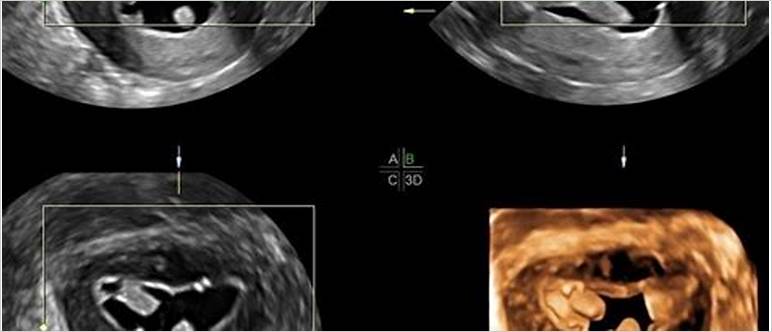 Pregnancy after saline ultrasound